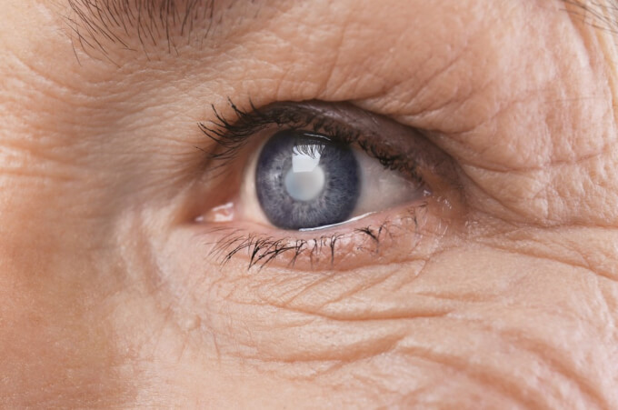 Tips to Reduce Your Risk of Glaucoma